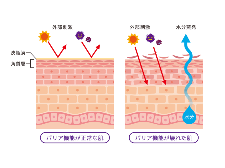 マスク生活で ニキビ に悩む人が増加中 ニキビの原因と予防のためのケアとは