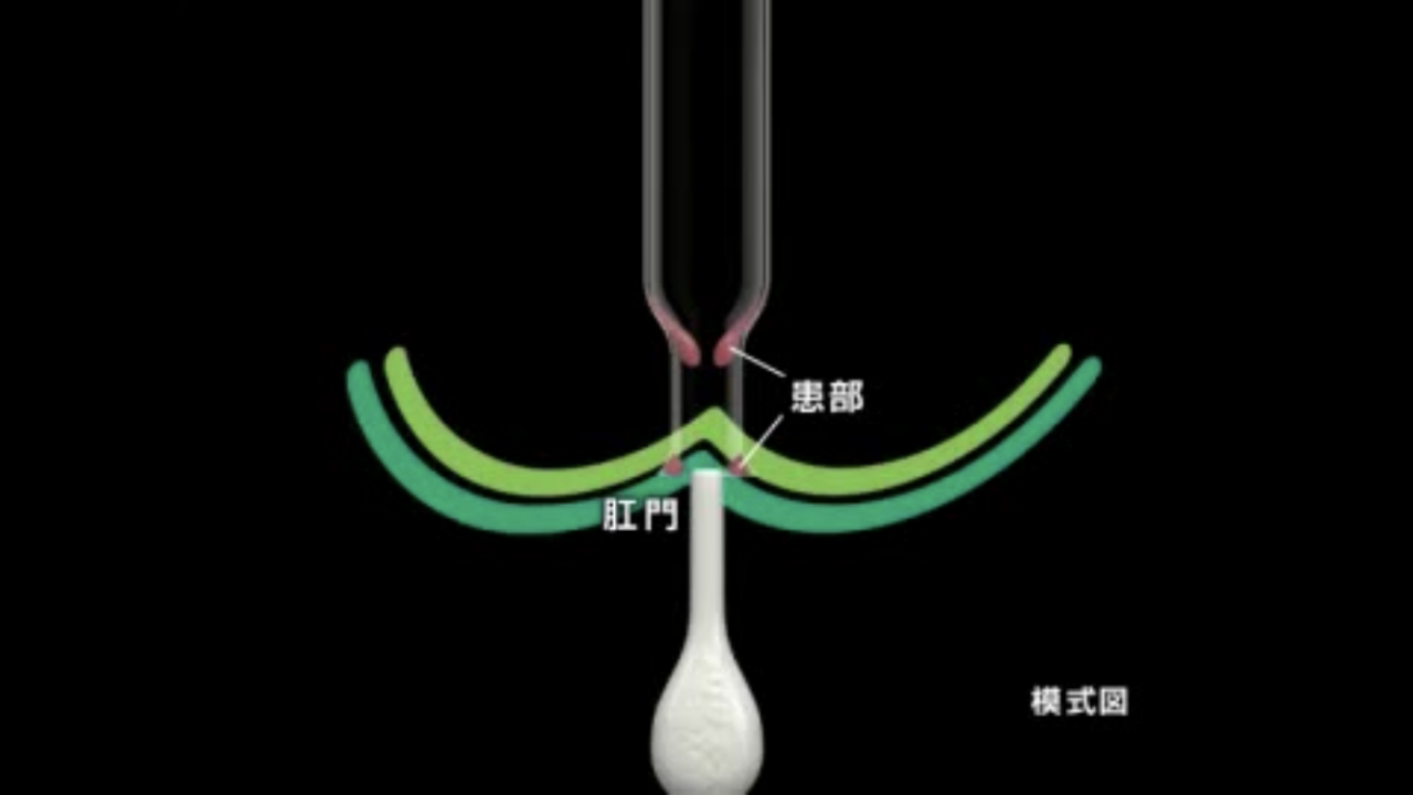 【プリザ注入軟膏】止まって留まるメカニズム