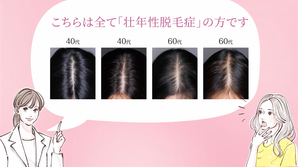 壮年性脱毛症の動画
